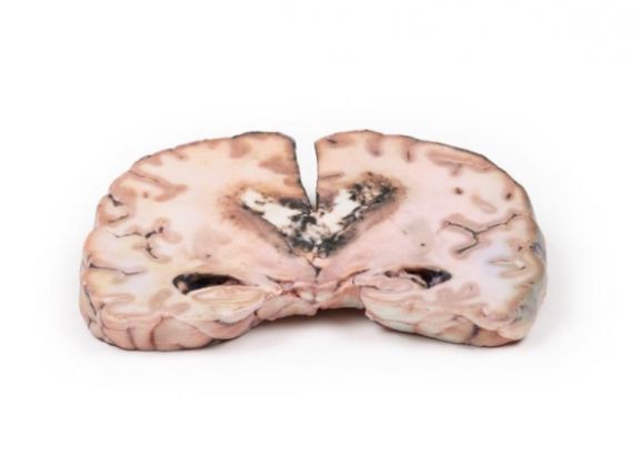 https://www.jayakelana.jayakelana.id/uploads/product/-mp2003-glioma-grade-3-4--15959f8d55a3304_cover.jpg